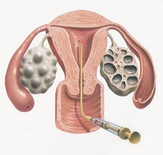 Перенос эмбрионов в полость матки